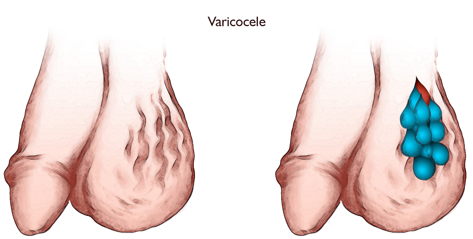 Varicocele: Should You Stop Wearing Underwear?