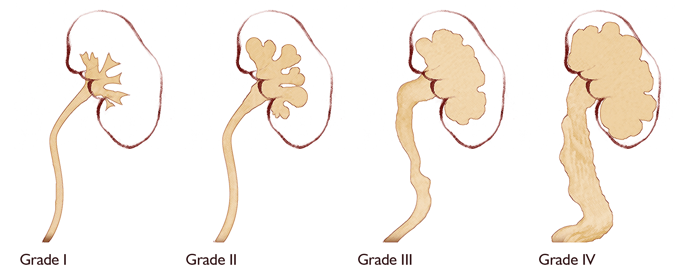 Hydronephrosis Children s Hospital Of Orange County Hydronephrosis Children s Hospital Of Orange County