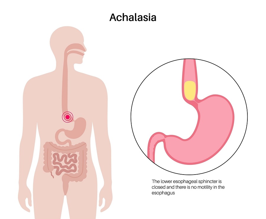 Diagram showing the narrowing of the lower esophageal sphincter in a case of achalasia