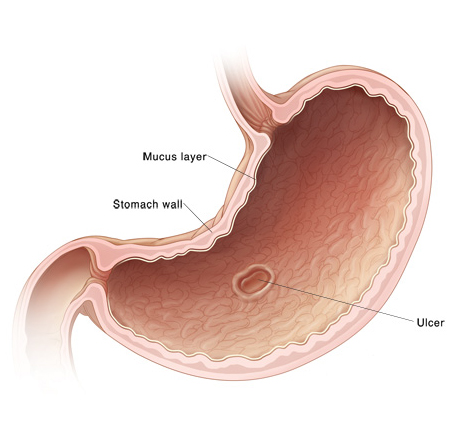 Diagram of stomach showing an ulcer in the stomach lining, or duodenum.