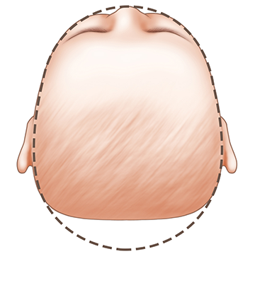 baby head shape brachycephaly