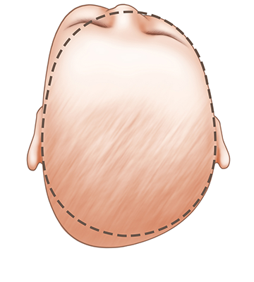 baby head shape lambdoid synostosis