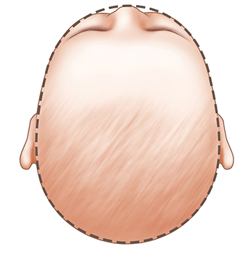 baby head shape coronal synostosis