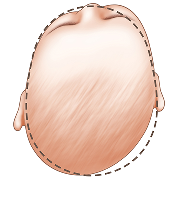 Baby head shape plagiocephaly