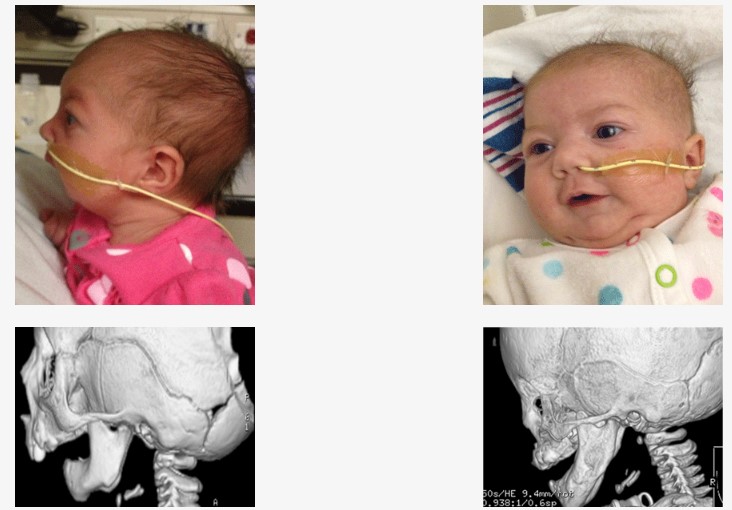 Before and after jaw surgery
