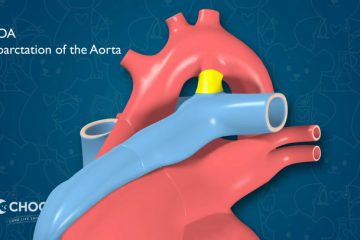 Heart – Coarctation of the Aorta