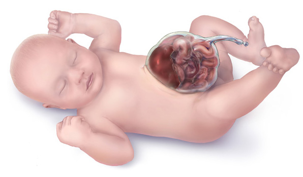 Infant Omphalocele