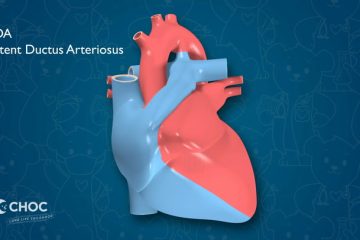 Heart – Patent Ductus Arteriosus