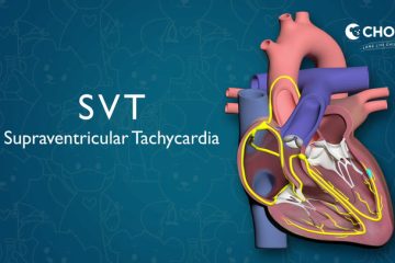 Heart - Supraventricular Tachycardia