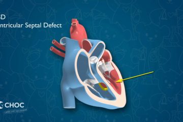 Heart - Ventricular Septal Defect