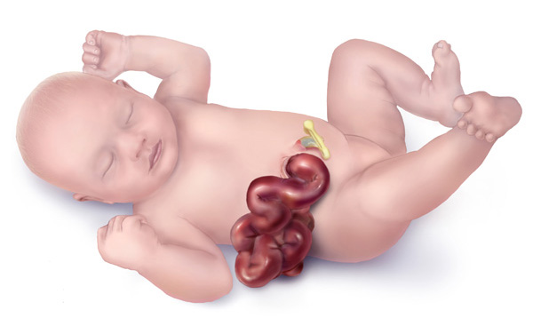 gastroschisis in baby