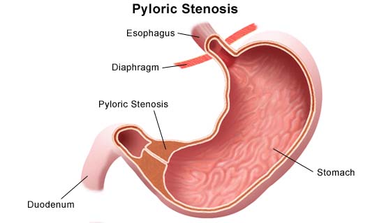 Pylotric Stenosis graphic