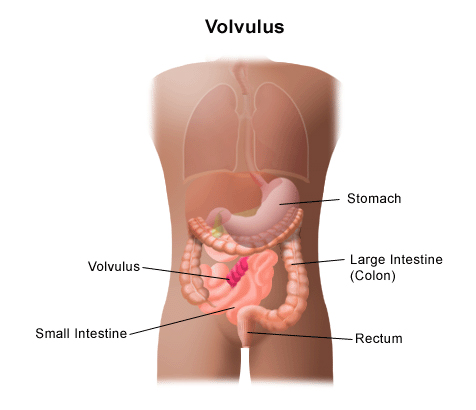 Volvulus graphic