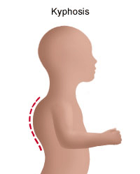 Kyphosis diagram showing curve of spine