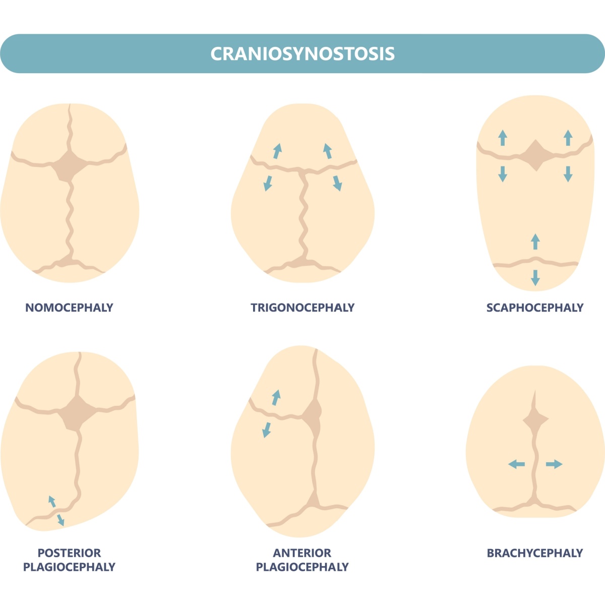 Scaphocephaly Causes Scaphocephaly Causes