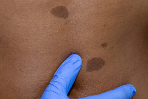 Neurofibromatosis Program