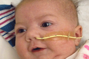 Mandibular Distraction Osteogenesis