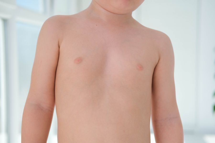 School Nurse Virtual Education Series - Pectus Excavatum