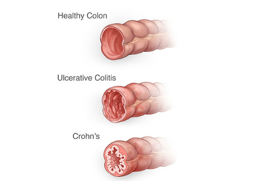 health colon versus ulcerative colitis colon versus crohn's disease colon diagram