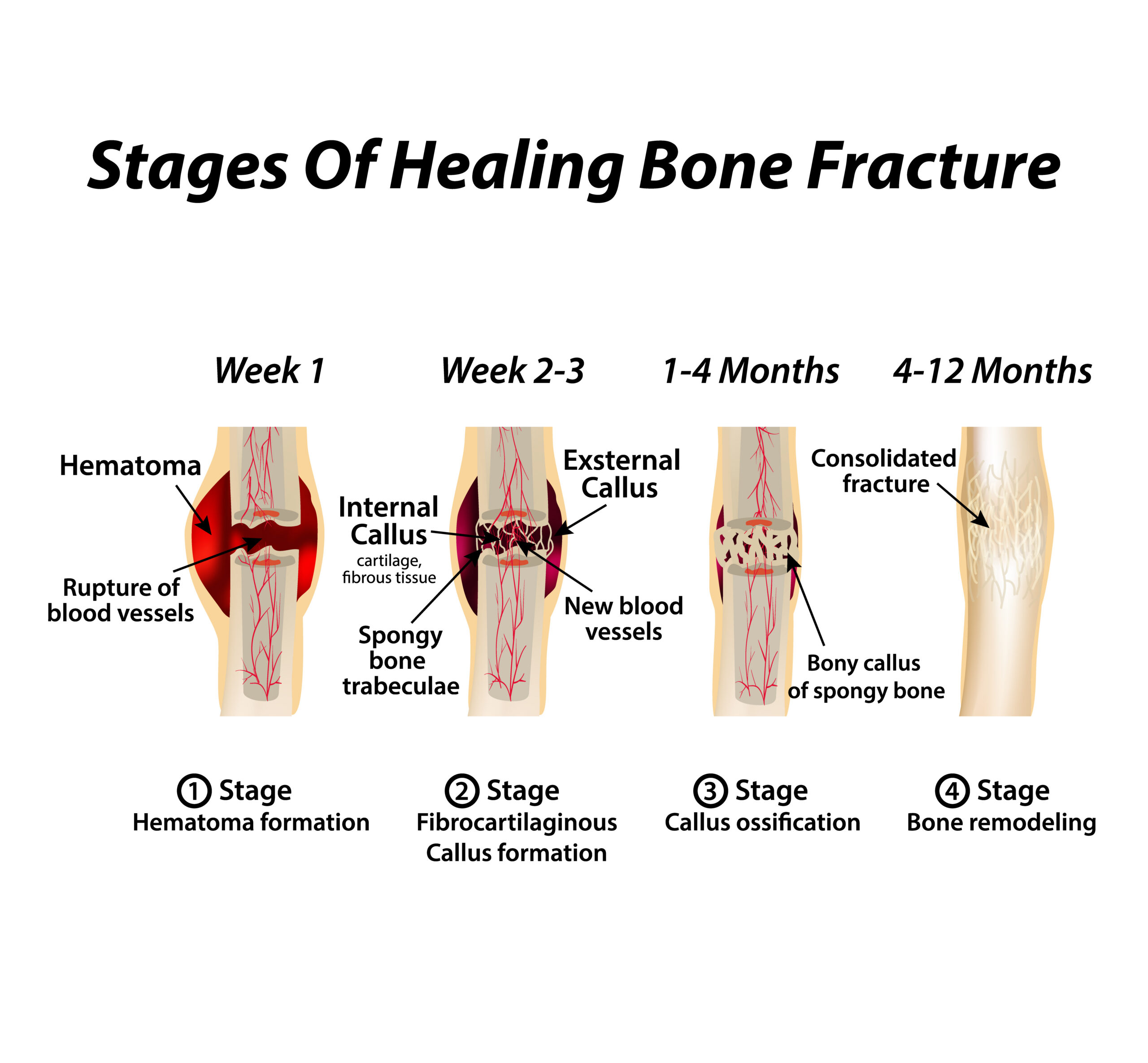stages of healing bone fracture