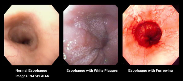 Eosinophilic Esophagitis - Endoscopy Campus