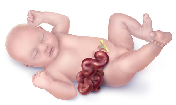 SimplyThick May Be Damaging Infants' Intestines : Shots - Health News : NPR