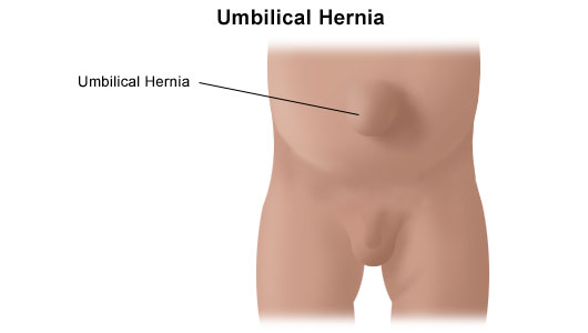 Report a Case of Umbilical Cord Hernia in a Neonate