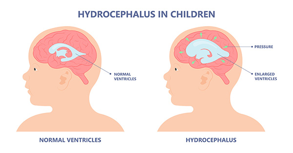 hydrocephalus baby signs