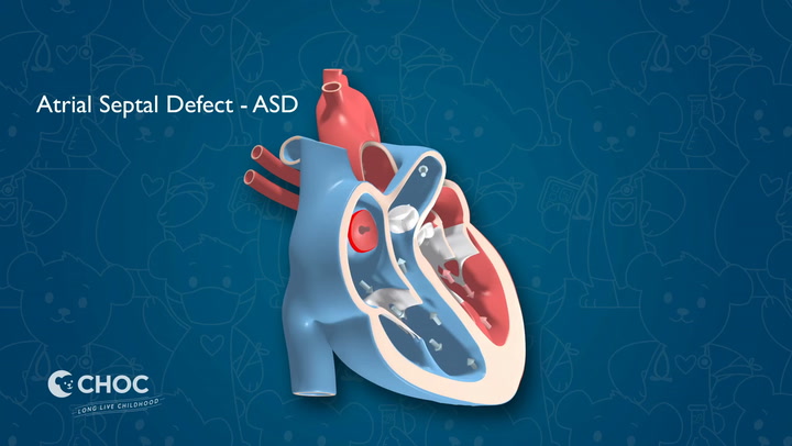 Heart - Atrial Septal Defect - Children's Hospital Of Orange County