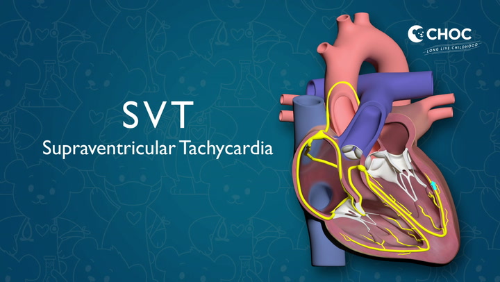 Heart - Supraventricular Tachycardia - Children's Hospital of Orange County